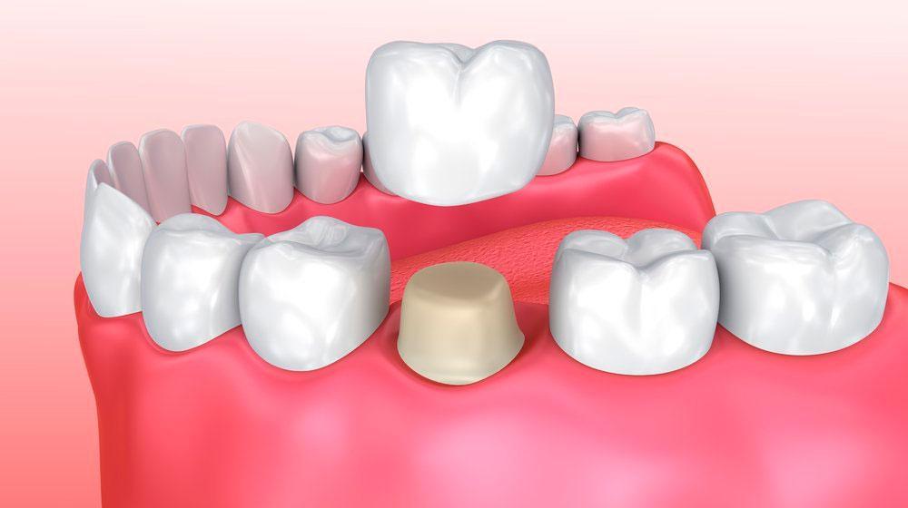 Crowns - All Smiles Dentistry