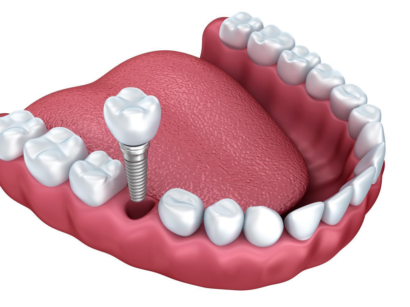 Dental Implants in Foothill Ranch CA - All Smiles Dentistry